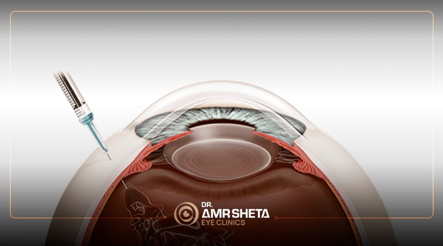 Intravitreal Injections For Retinal Diseases (IVI) – Dr. Amr Sheta