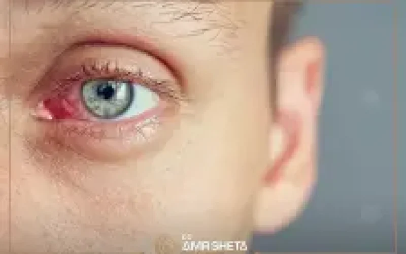 احمرار العين بعد عملية المياه البيضاء